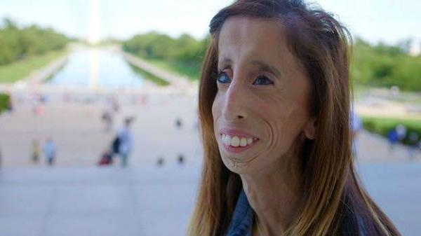 Lizzie Velasquez(Imagem:MSN)