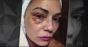 Luiza Brunet em foto feita após agressão que ela afirma ter sofrido do ex-marido, Lírio Parisotto.(Imagem:Reprodução TV Globo / Fantástico)