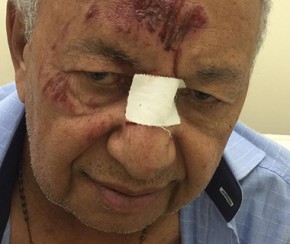 Dr. Pessoa é atropelado por motocicleta e sofre lesões no rosto.(Imagem:Reprodução/ WhatsAAp)