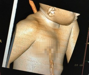 Tomografia mostra localização do pedaço de madeira no corpo da criança.(Imagem:Cidadeverde.com)