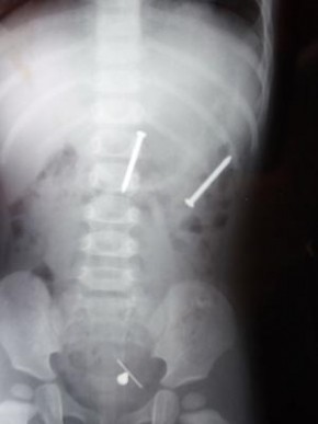 Radiografia do corpo da menina.(Imagem: Europics)
