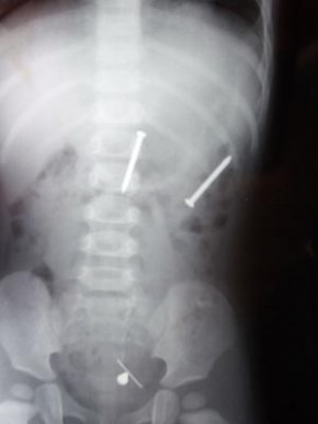 Radiografia do corpo da menina.(Imagem: Europics)