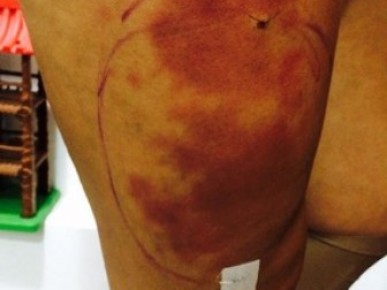 Cirurgia para retirada de próteses da perna de Andressa Urach.(Imagem:Divulgação)
