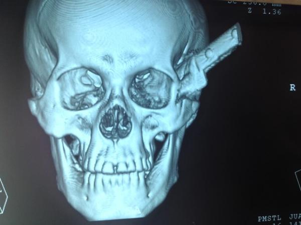 Em tomografia é possível ver a faca cravada no crânio do homem.(Imagem:Ellyo Teixeira/G1)