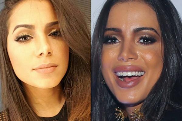 Clínica diz que se recusou a fazer novo preenchimento labial em Anitta.(Imagem:Reprodução / Instagram | Manuela Scarpa/ Brazil Ne)