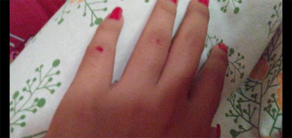 Estudante ficou com marcas da agressão na mão.(Imagem:Arquivo pessoal)