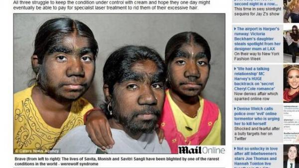 As indianas têm a síndrome do lobisomem.(Imagem:Reprodução / Daily Mail  )