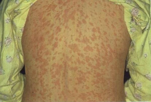 Manchas vermelhas pelo corpo podem aparecer em pessoas que contraíram sarampo.(Imagem:Divulgação/Sesa-ES)