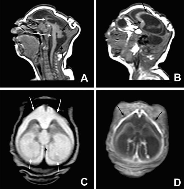 Exame de imagem revela danos cerebrais de bebês com microcefalia.(Imagem:BMJ 2015)