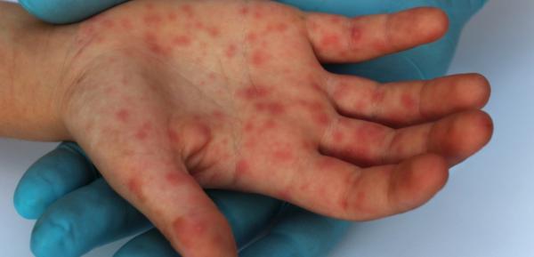 Manchas vermelhas pelo corpo são sintoma de sarampo.(Imagem:Febrasgo.org/Divulgação)
