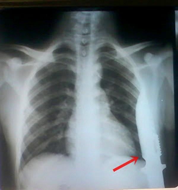 Radiografia de Marcelo (Imagem:blog do Yuri Junior)