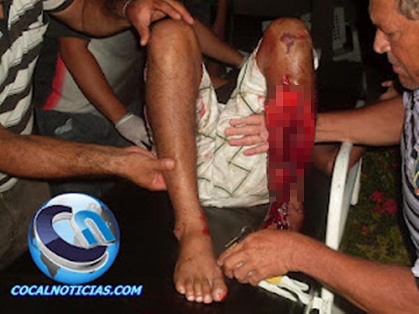 Colisão de moto com trator deixa motoqueiro e garupeiro com fraturas expostas nas pernas.(Imagem:Blog Cocal Notícias )