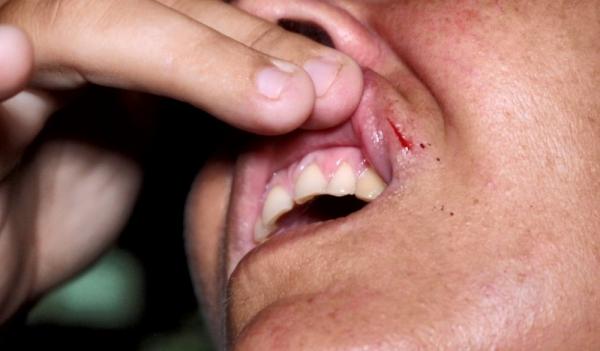 Boca da árbitra ficou ferida devido às agressões.(Imagem:Kairo Amaral/TV Clube)