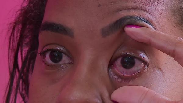 Ridja Dutra teve queimadura na retina após usar pomada modeladora.(Imagem:Reprodução/TV Globo)