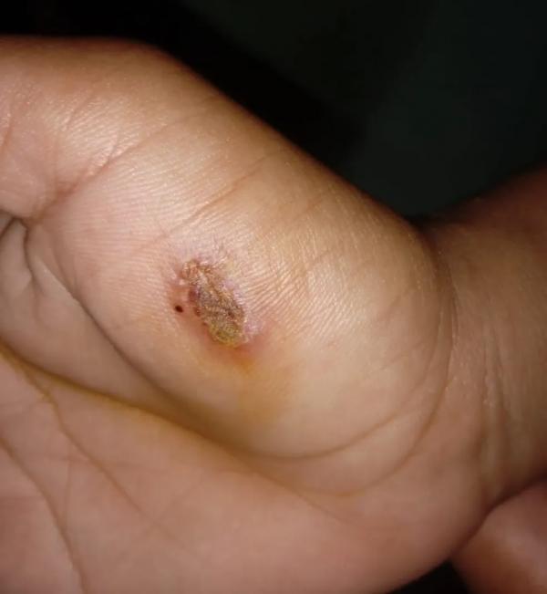 Lesão provocada por mordida em adolescente de 16 anos.(Imagem:Divulgação/Polícia Civil)