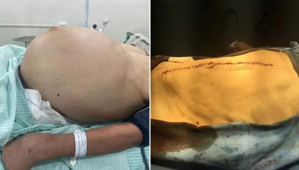 Médicos retiram tumores pesando quase 11 kg de paciente idosa em Floriano.(Imagem:Hospital Tibério Nunes)