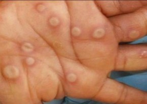 Sobe para 18 os casos confirmados de varíola dos macacos no Piauí(Imagem:Divulgação)