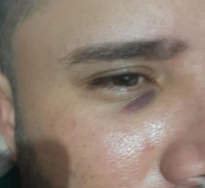 Marcas de agressão no rosto do empresário Jailton Pinto, que ele relata terem sido feitas pelo atacante Juninho.(Imagem:Arquivo Pessoal)
