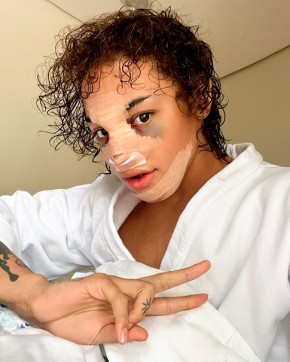 A cantora Pabllo Vittar publicou nas redes sociais nesta sexta-feira, 17, uma série de selfies em que aparece com curativos e hematomas pelo rosto. Isso porque a drag queen fez uma(Imagem:Reprodução)