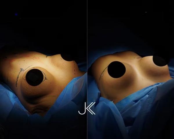 Veja o antes e depois da cirurgia de Lorena Maria.(Imagem:Divulgação)