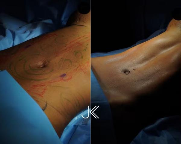 Veja o antes e depois da cirurgia de Lorena Maria.(Imagem:Divulgação)