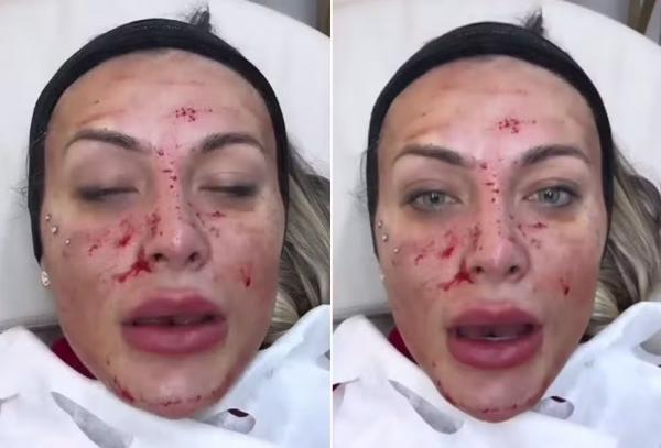Andressa Urach mostra rosto sangrando após procedimento.(Imagem:Reprodução/Instagram)