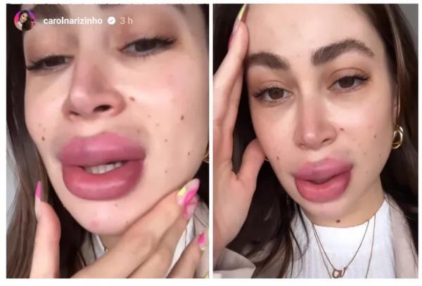 Carol Narizinho mostra boca superinchada após retirar preenchimento labial.(Imagem:Reprodução/Instagram)