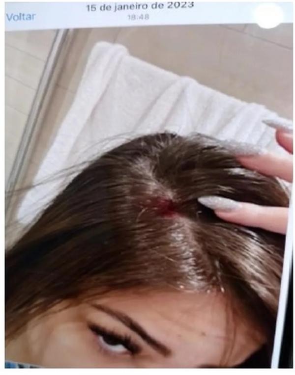 Gabriela Cavallin com ferimento na cabeça.(Imagem: Reprodução)