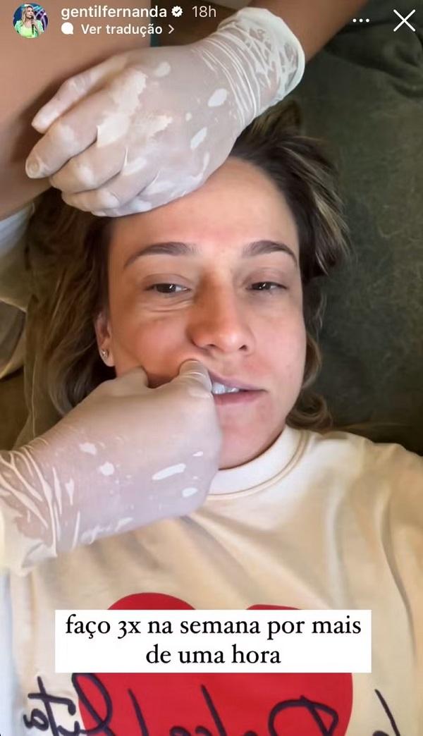 Fernanda Gentil mostra tratamento para Paralisia de Bell.(Imagem:Reprodução/Instagram)