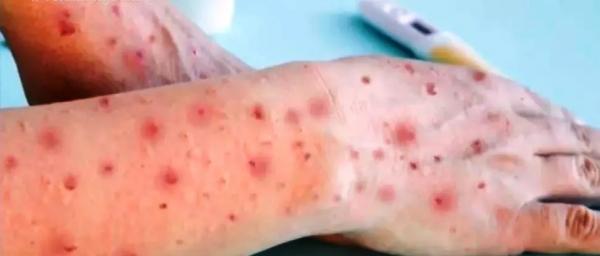 Erupções cutâneas são típicas nos casos de varíola dos macacos.(Imagem:Reprodução/TV Anhanguera)