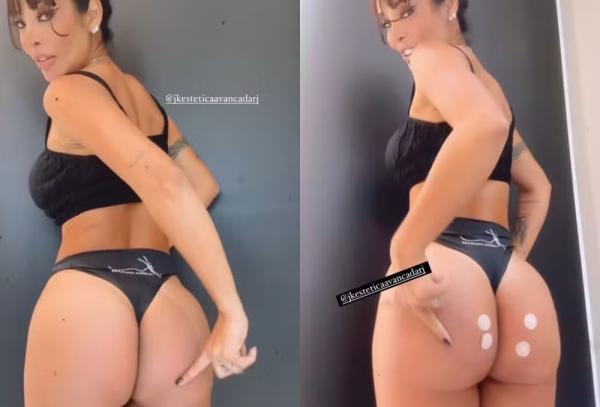 Carol Nakamura mostra antes e depois de procedimento no bumbum.(Imagem:Reprodução/Instagram)