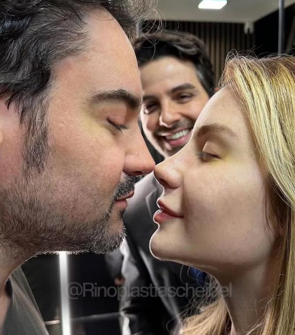 Fernando Zor e Lara Bissi mostram resultados de suas rinoplastias.(Imagem:Reprodução/Instagram)