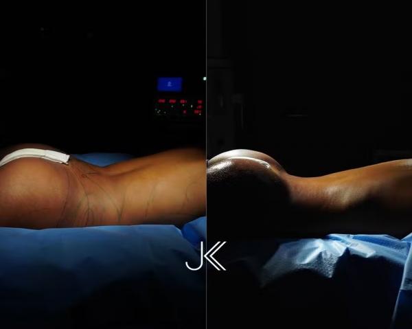 Veja o antes e depois da cirurgia de Lorena Maria.(Imagem:Divulgação)