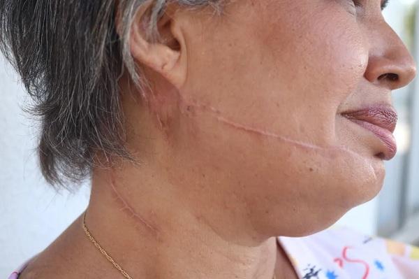  Marcas das agressões sofridas por Guilhermina Ferreira.(Imagem:Lucas Marreiros /g1 )