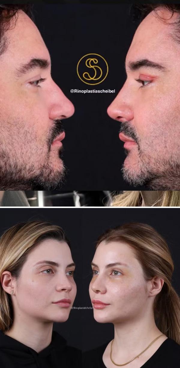 Fernando Zor e Lara Bissi antes e depois de rinoplastia.(Imagem: Reprodução/Instagram)