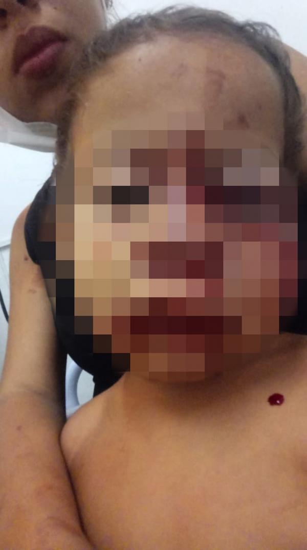 Menino de 2 anos tem rosto desfigurado após ataque de cachorro em São Julião, no Piauí.(Imagem:Reprodução)