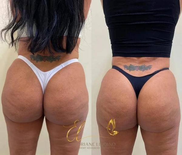 Gretchen mostra antes e depois de procedimento no bumbum(Imagem:Divulgação)