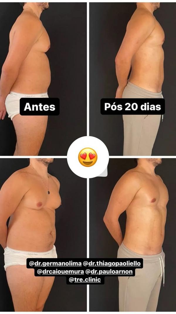 Eliezer mostra antes e depois da cirurgia.(Imagem:Reprodução/Instagram)